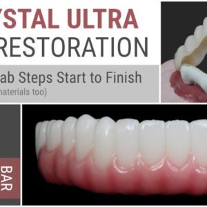 AOX Crystal Ultra Hybrid Restoration – ALL Clinical & Lab Steps Start to Finish
