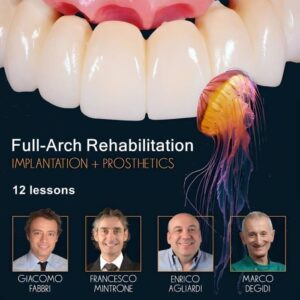 Full-Arch Rehabilitation: Implantation and Prosthetics