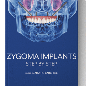 Zygoma Implants: Step by Step 1st Edition