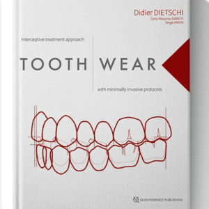Tooth Wear: Interceptive Treatment Approach With Minimally Invasive Protocols